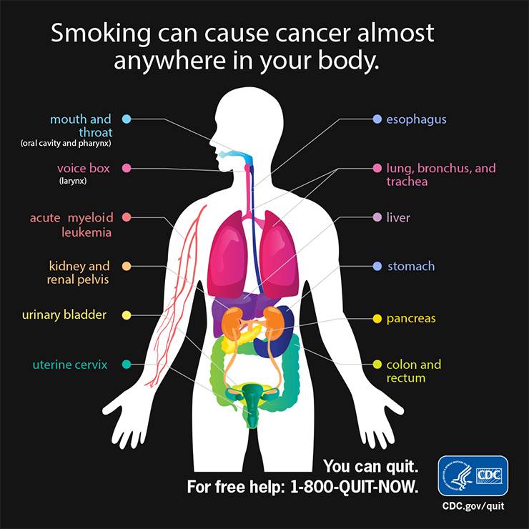 An infographic shows where smoking can cause cancer in the body. Image courtesy of the Centers for Disease Control and Prevention.